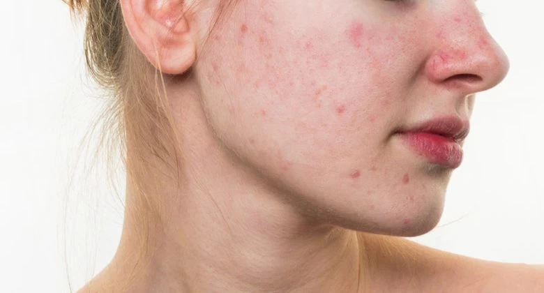 Ακμή: Τι μπορεί να δείχνει για την υγεία σας το πού εμφανίζονται σπυράκια